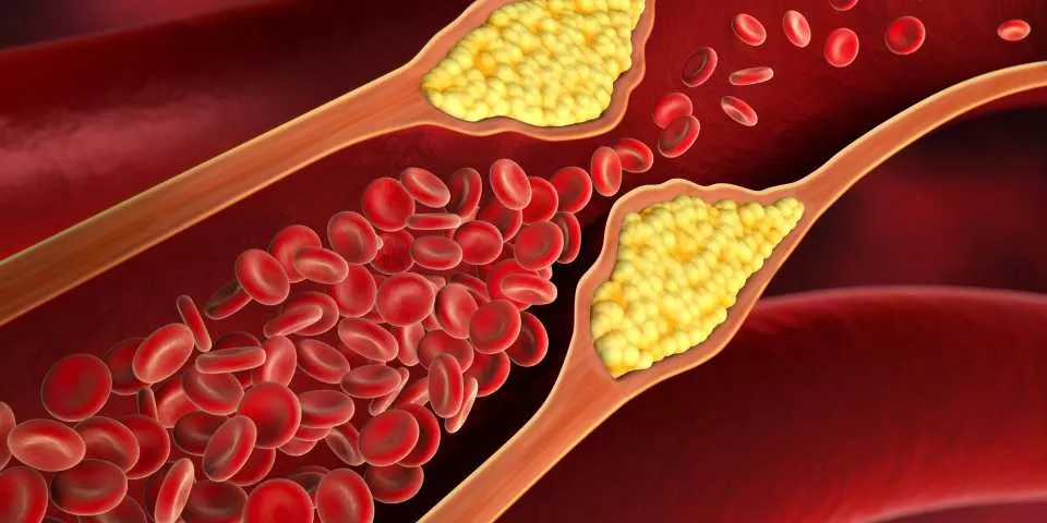 Triglicérides nas paredes dos vasos