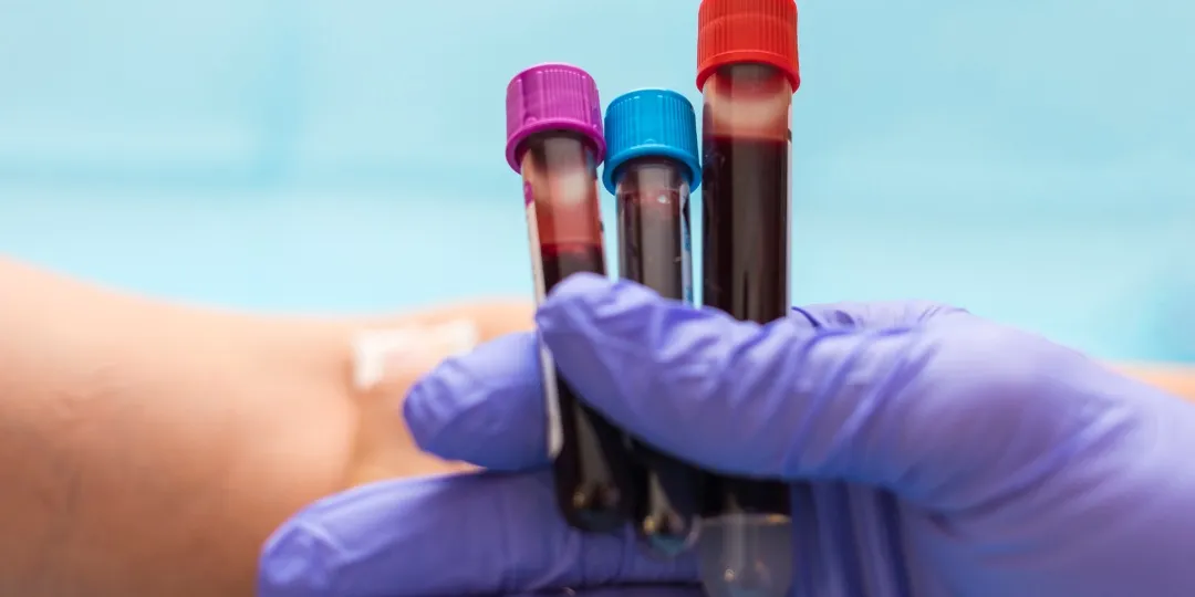 Mão de profissional da saúde segurando coleta de sangue